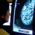 ‘Worrying’ figures show 10,000 fewer people starting breast cancer treatment